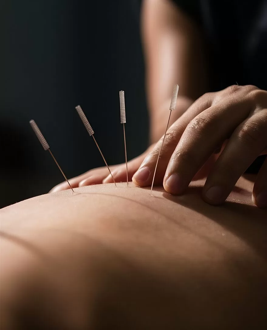 Procedimento de acupuntura